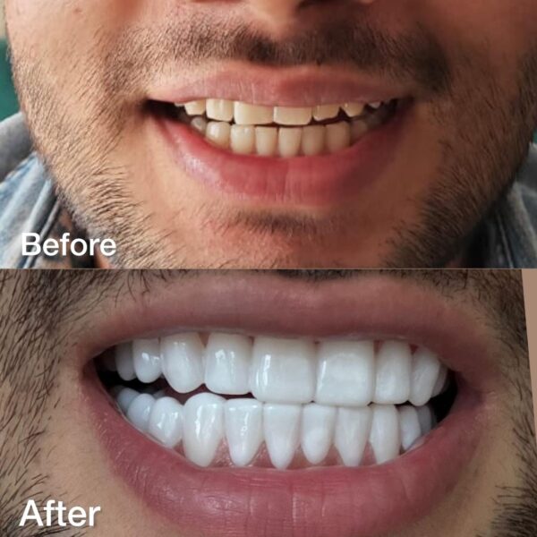 Dreamsmile Veneers Impression Kit / Scan - Image 9