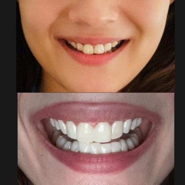 Dreamsmile Veneers Impression Kit / Scan - Image 8