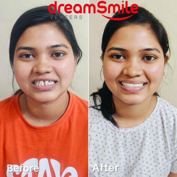 Dreamsmile Veneers Impression Kit / Scan - Image 6